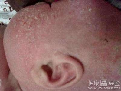 寶寶濕疹吃什麼好得快