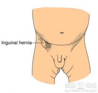 小兒疝氣有什麼危害