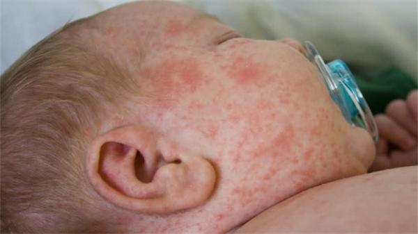 寶寶痱子怎麼辦?
