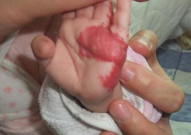 小寶寶應該怎麼預防和清胎毒?