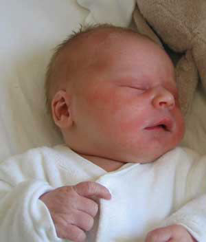 怎樣辨別是痱子還是濕疹?痱子和濕疹的區別