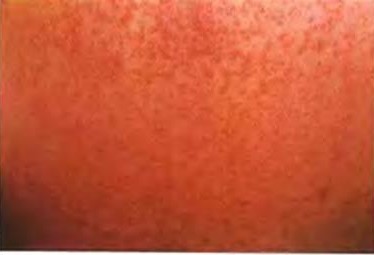 如何治療痱子 痱子的症狀(圖片)